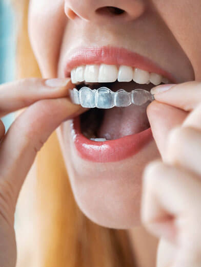 clear aligners